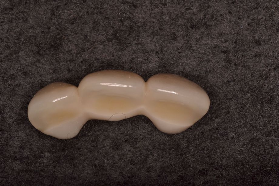 オールセラミック(全てセラミックで出来ているので審美的に最も優れています)04