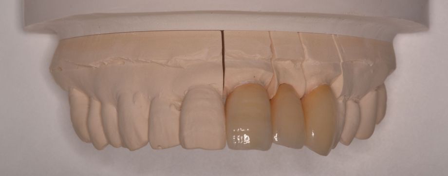 オールセラミック(全てセラミックで出来ているので審美的に最も優れています)02