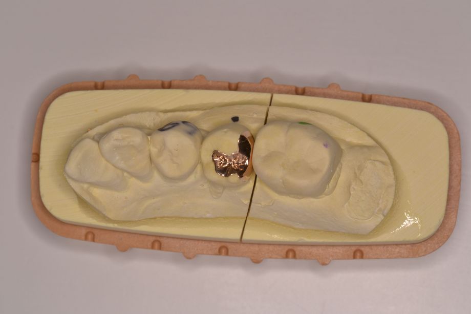 ゴールドインレー