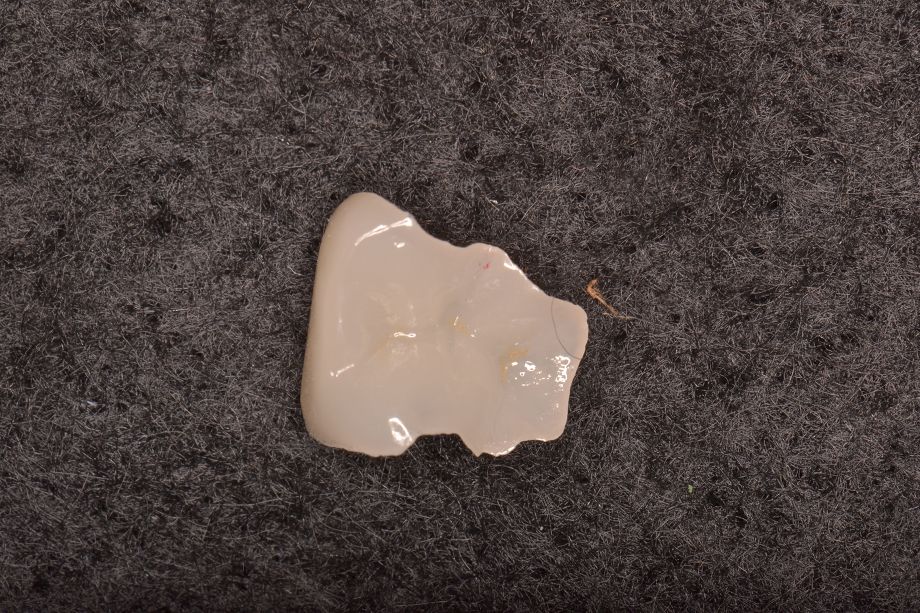 セラミックインレー02