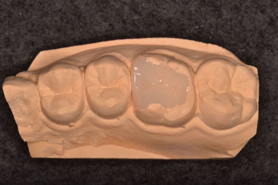 セラミックインレー