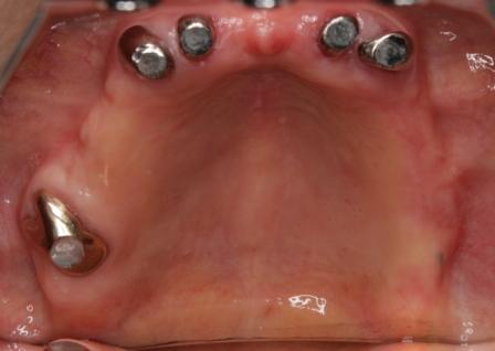 アタッチメント02